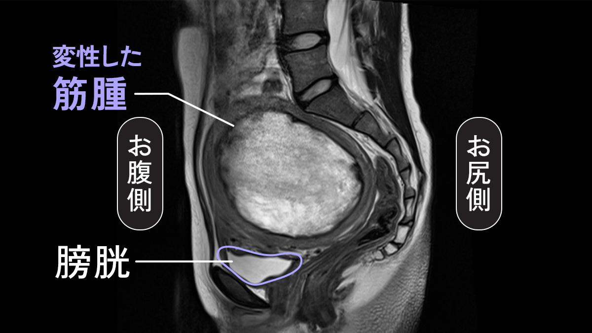 子宮筋腫MRI画像