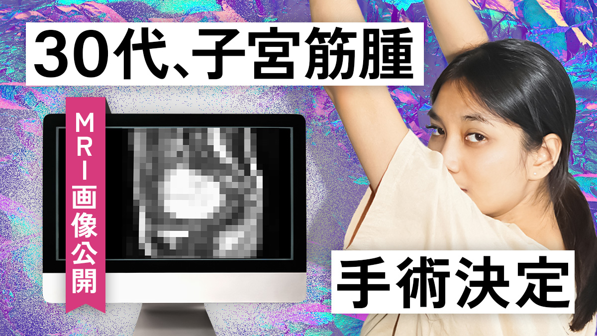 30代女性と子宮筋腫